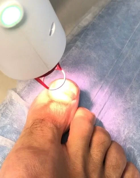 laser para tratamento de onicomicose