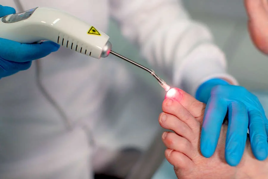 laser para tratamento de onicomicose