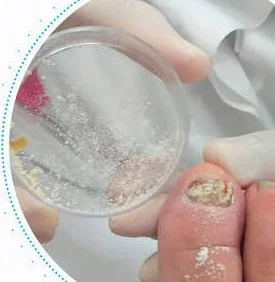 teste laboratorial de micose