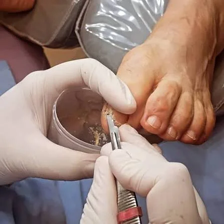 teste laboratorial de micose