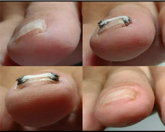 serviço de corretor de unhas