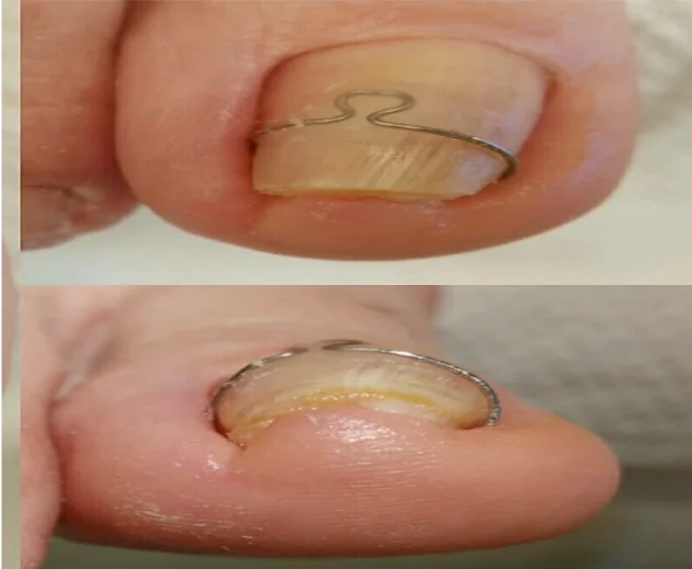 serviço de corretor de unhas