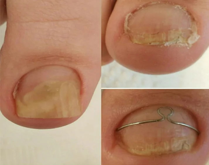 serviço de corretor de unhas