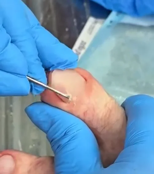 remoção de unhas