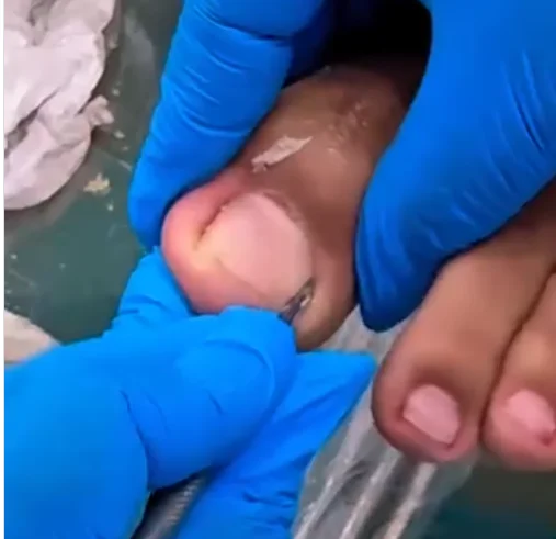 remoção de unhas