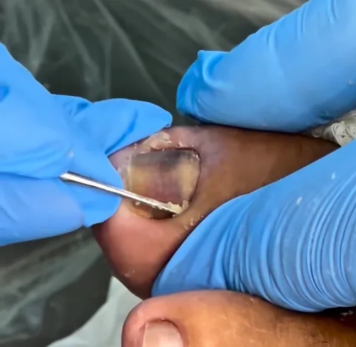 remoção de unhas