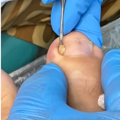 remoção de unhas